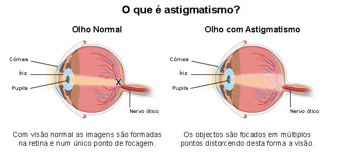 Astigmatismo - o que é, sintomas, causas, cirurgia, tem cura?