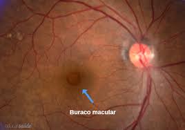 Buraco Macular: causas, sintomas e tratamento