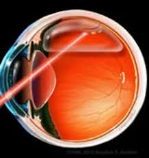 Cirurgia Catarata, Vitrectomia, Injeção intravítrea, Retina