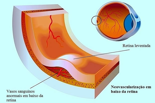 Descolamento de Retina em Curitiba | Dr. Alexandre Grandinetti