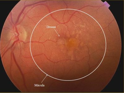 Fig. 1. Degeneração Macular forma seca com drusas