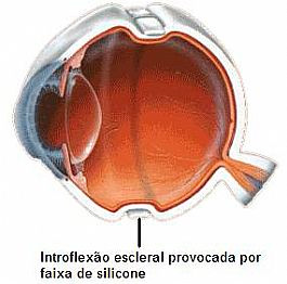 Fig. 3. Descolamento de Retina sendo tratado com introflexão escleral