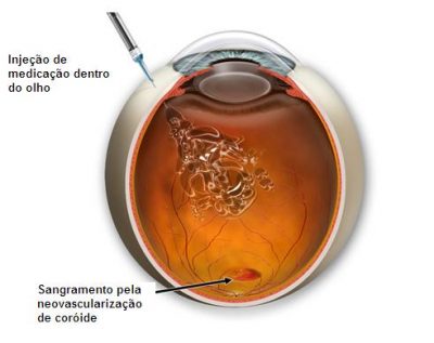 Fig 3. Ilustração de injeção intravítrea de Lucentis ou Avastin na Degeneração Macular