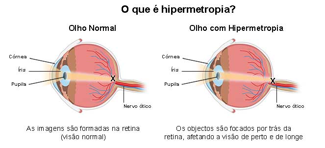 Hipermetropia - o que é, sintomas, causas, cirurgia, cura