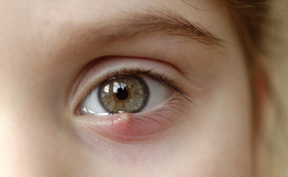 Centro de Olhos Santa Luzia - #CentroDeOlhosResponde: O hordéolo, mais  conhecido como terçol, é uma infecção dos folículos ciliares, que se  localizam na borda da pálpebra, perto dos cílios. É causado por
