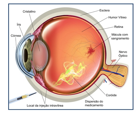 Injeção intravítrea: o maior avanço no tratamento farmacológico de ...