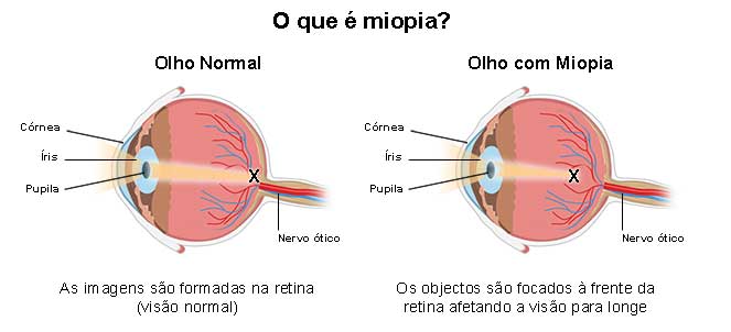 Miopia - o que é, sintomas, causas, graus, cura, correção