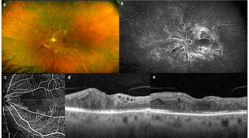 Multimodal imaging of a 59-year-old woman affected by diabetes ...