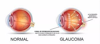 O que é glaucoma?