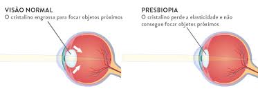 Presbiopia ou vista cansada: sintomas e tratamento | Lenscope