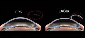 QUAL A DIFERENCÇA ENTRE A CIRURGIA REFRATIVA DE LASIK E A PRK ...