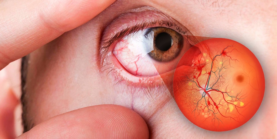 Retinopatia Diabética - Causas e Tratamentos - Clínica Oftalmed