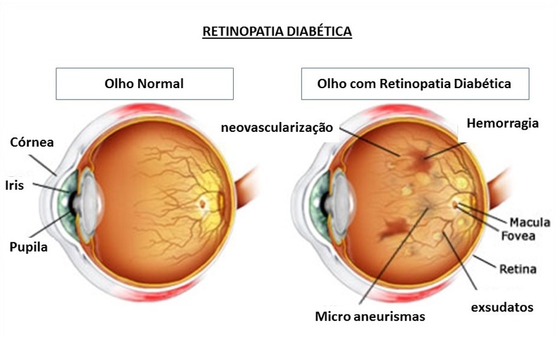 Retinopatia Diabética é uma das principais complicações da ...