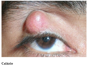 Clínica de olhos Levate - 👀 Terçol ou Hordéolo: 1. O que é? Pequeno nódulo  infeccioso na região palpebral, mais precisamente na base dos cílios.  Geralmente ocorre por uma obstrução das glândulas