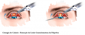 Clínica de olhos Levate - 👀 Terçol ou Hordéolo: 1. O que é? Pequeno nódulo  infeccioso na região palpebral, mais precisamente na base dos cílios.  Geralmente ocorre por uma obstrução das glândulas