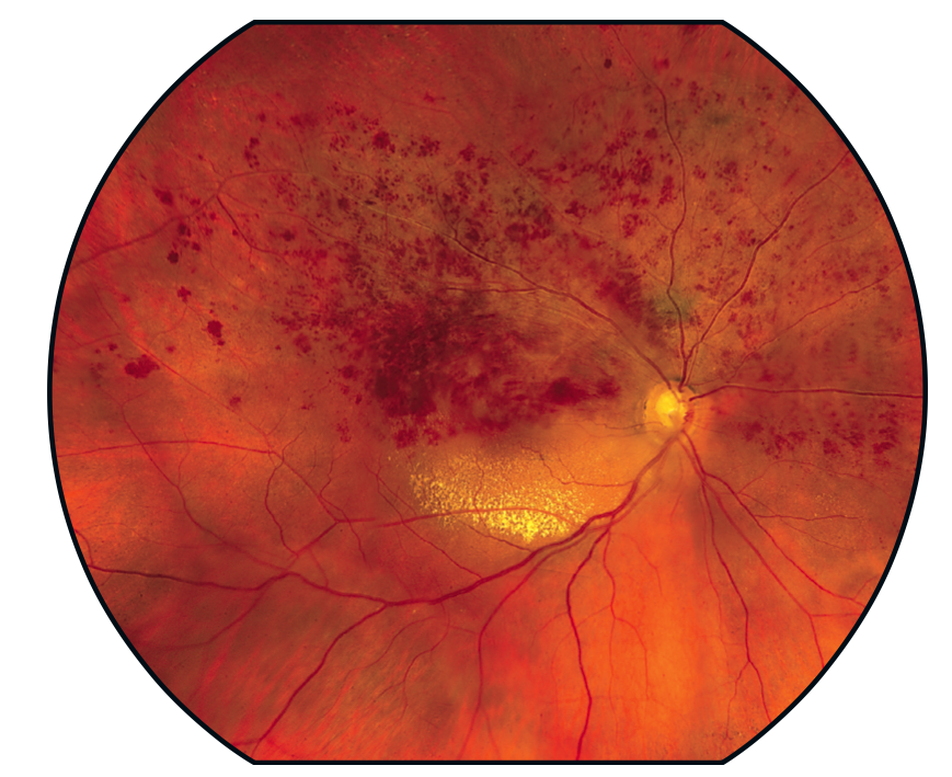 Calázio e hordéolo (terçol): Causas Sintomas e Tratamentos – EYECOLORS –  Vison Care